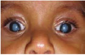 क्या मोतियाबिंद (Cataract) का ऑपरेशन दोबारा हो सकता है?