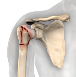 What is Shoulder Fracture? || image