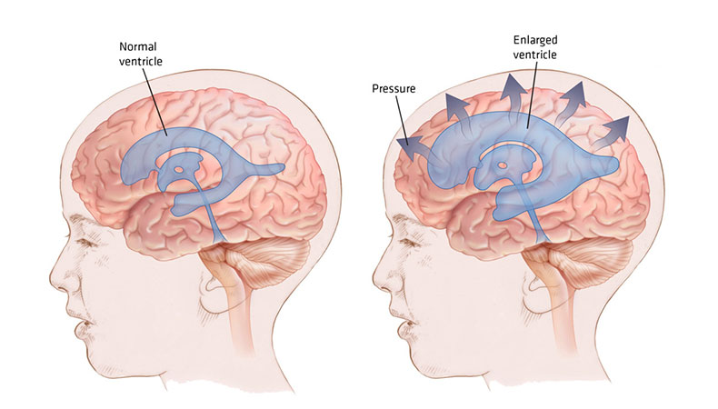 Who needs VP Shunt Procedure? || image