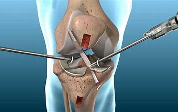 How is ACL Reconstruction Surgery done? || image